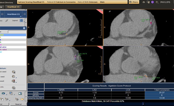 CT Calcium Scoring 