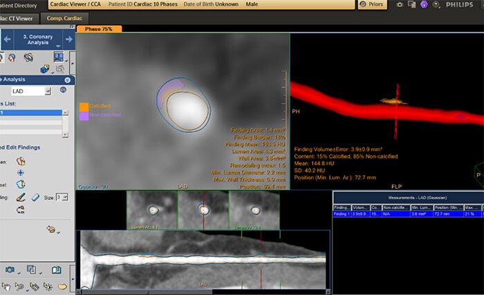 CT Cardiac Plaque Assessment 