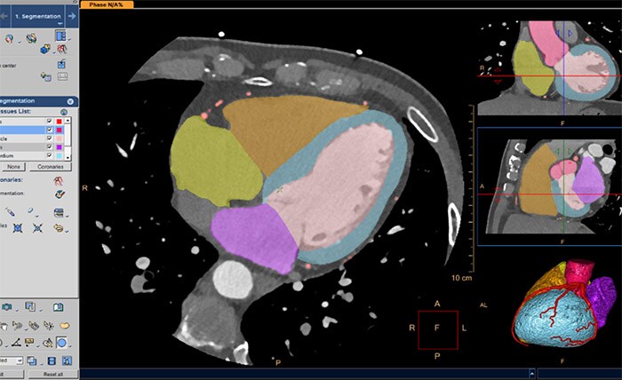 CT Comprehensive Cardiac Analysis (CCA) 