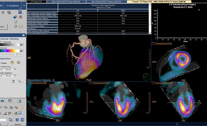 CT Comprehensive Cardiac Analysis CT-MI Fusion