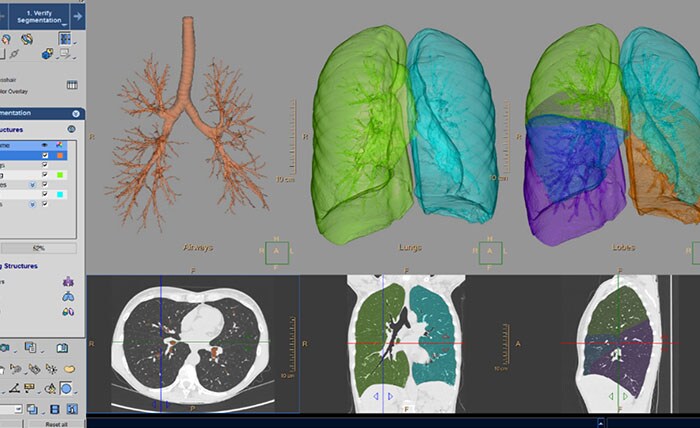 CT Chronic Obstructive Pulmonary Disease (COPD) 