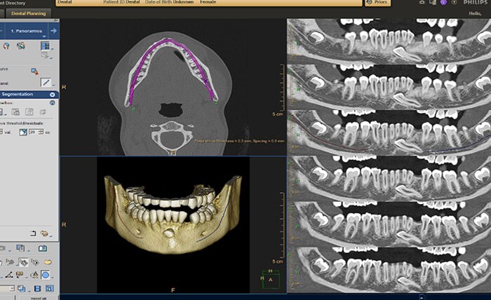 CT Dental Planning 