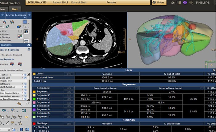 CT Liver Analysis