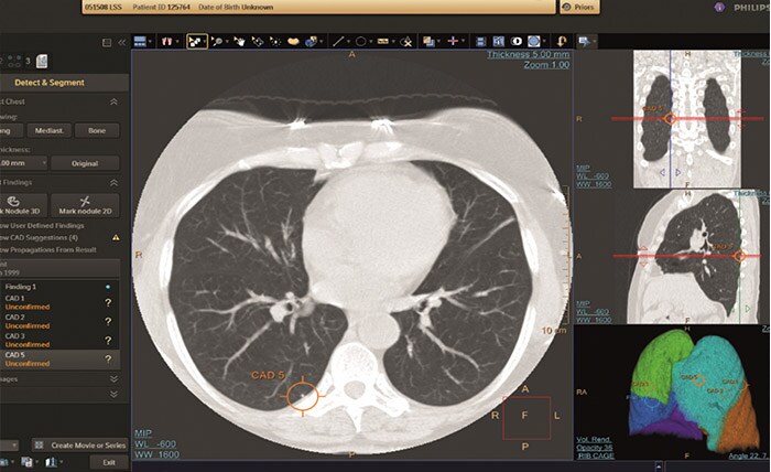 CT Lung Nodule Assessment (LNA) CAD 
