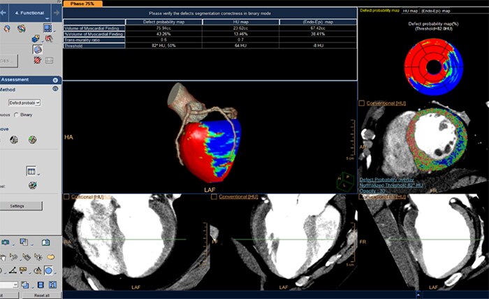 CT Myocardial Defect Assessment