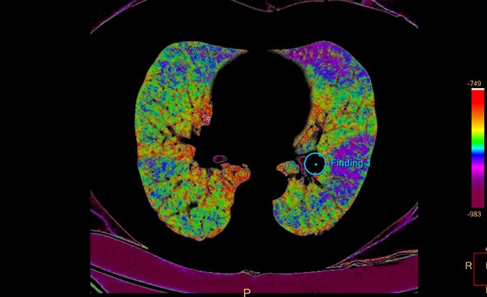 CT Pulmonary Artery Analysis 