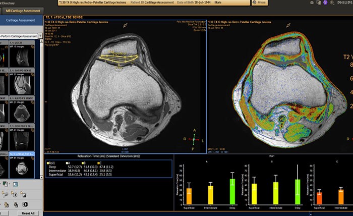 MR Cartilage Assessment