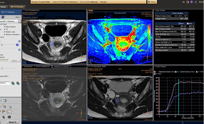 MR T1 Perfusion