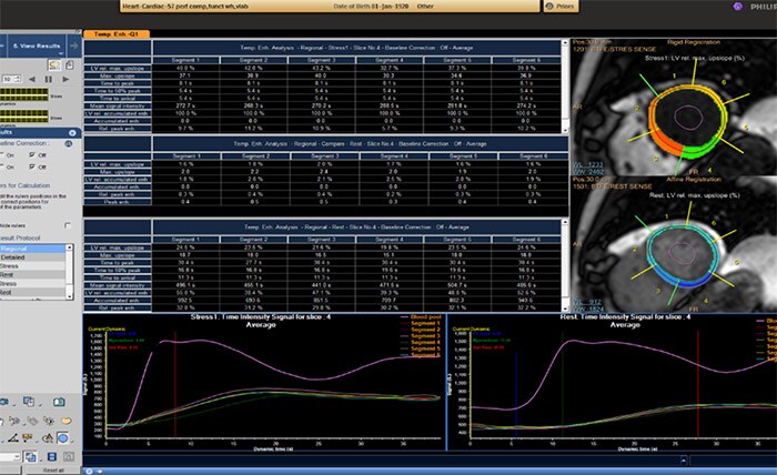 MR Cardiac Temporal Enhancement