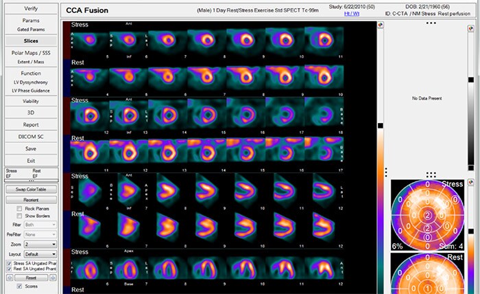 NM Emory Cardiac Toolbox (ECTb) HeartFusion 