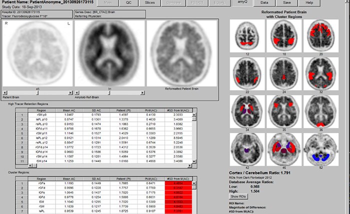 NM NeuroQ Amyloid