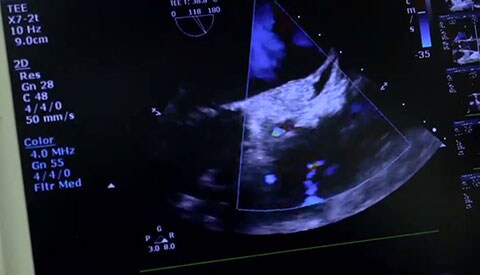 Применение технологии Live xPlane для контроля за успешностью имплантации клапана