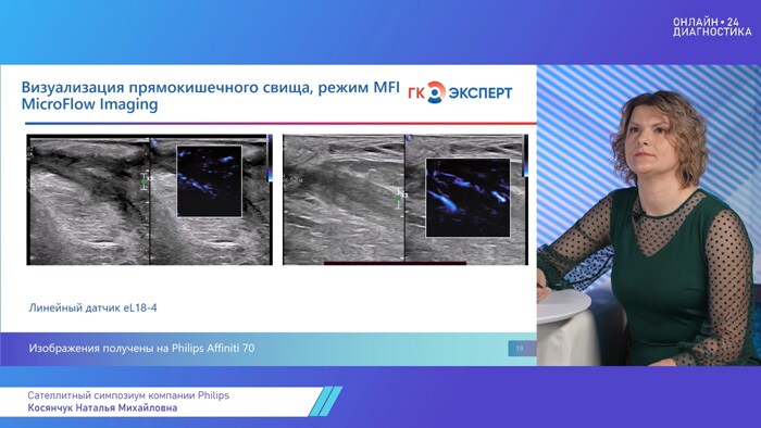 Запись симпозиума &laquo;Ультразвуковая диагностика парапроктитов&raquo;