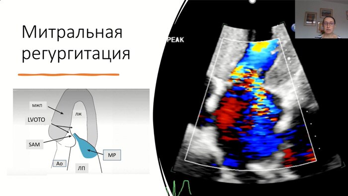 Многообразие фенотипов ГКМП. Эхокардиография и функциональные пробы в диагностике.