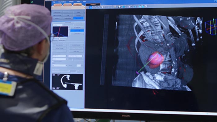 Биопсия и абляция опухоли