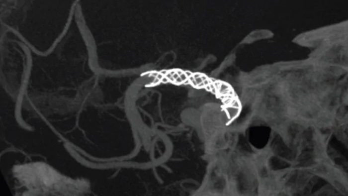 SmartCT&nbsp;Vaso&nbsp;IA image