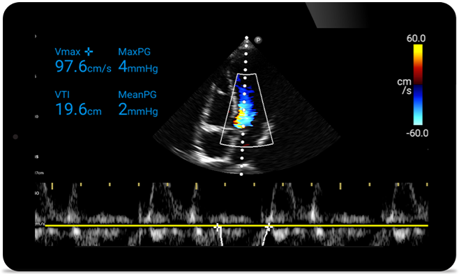 Действуйте быстрее, чтобы защитить сердце пациента