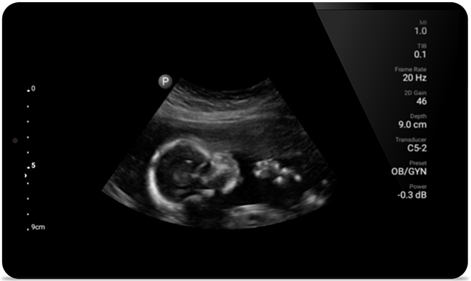 Результаты ультразвукового исследования