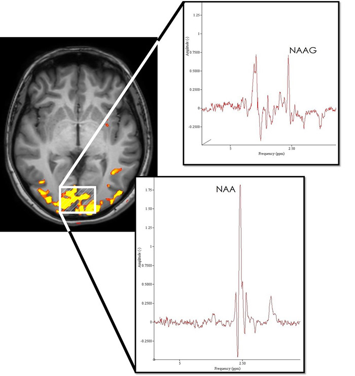fMRI image