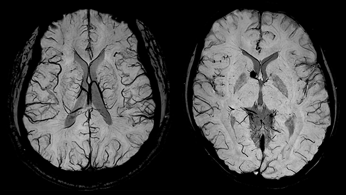 Проекции минимальной интенсивности SWI изображений.